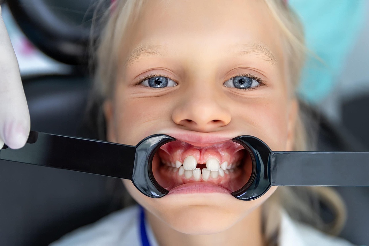 Lippenbändchen Op Wie Lange Schmerzen www.drbaader.de
