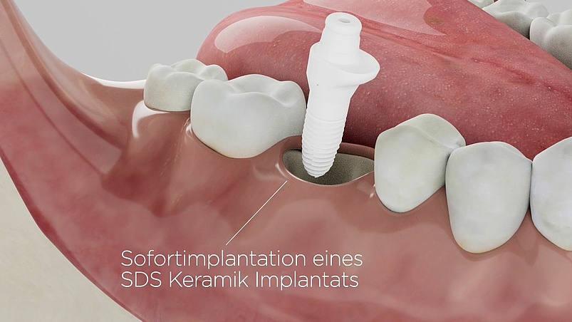 Keramikimplantate / Biologische Zahnheilkunde