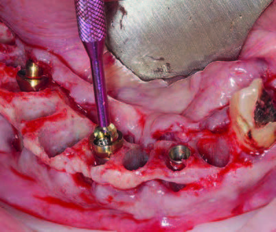 Inserierte Implantate regio 32, 42, 45 mit Multi-Unit Abutments regio 42, 45 sowie Multi-Unit Halterung regio 42.