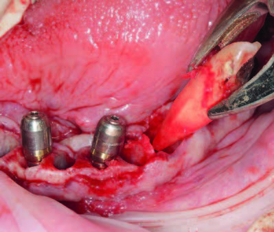 Aufschrauben der Heilkappen auf die Multi-Unit Abutments regio 32, 42, 45 sowie Extraktion des Zahnes 35.