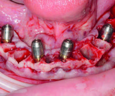 Inserierte Implantate regio 35, 32, 42, 45 mit aufgeschraubten Heilkappen.