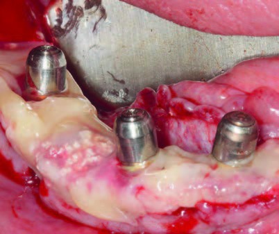 Augmentation mit porcinem KEM/autologem Knochen, autologen Fibrinmembranen (PRGF); anschließend Wundverschluss.