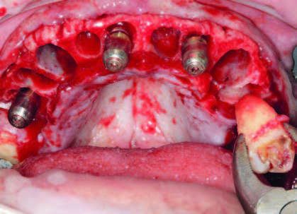 Implantate regio 15, 12, 22 mit Heilkappen, Extraktion der Zähne 16 und 24, anschließend Implantation regio 25.