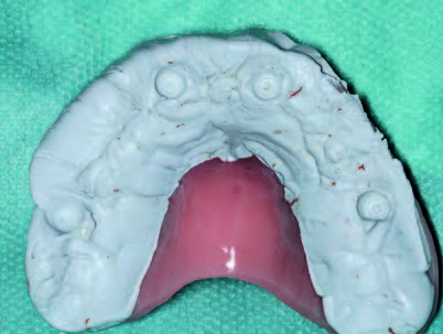 Impressionen der Heilkappen im Silikon zur Überführung in den Artikulator; Abformung der OK-Implantate analog zum UK.