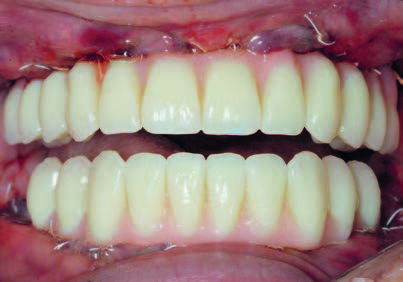 Abends postoperativ: Fest eingeschraubte All-on-4 Brücken im OK und UK; Verzicht auf 36, 46 (Vermeidung exzentrischer Kräft e).