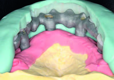 Zwölf Wochen post op.: OK/UK-Unterfütterung und Einarbeitung zahnunterstützender, CAD/CAM-gefertigter Titangerüste …