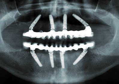 Im selben Termin röntgenologische Kontrolle (OPG): Erfolgreiche Osseointegration der Implantate im OK und UK.