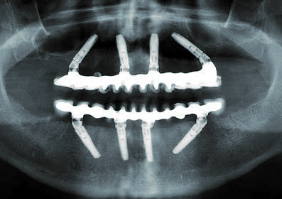 Im selben Termin röntgenologische Kontrolle (OPG): Erfolgreiche Osseointegration der Implantate im OK und UK.