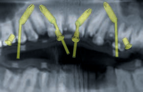 DVT-Planung: Implantate distal anguliert (OK: Schonung der Kieferhöhlen).