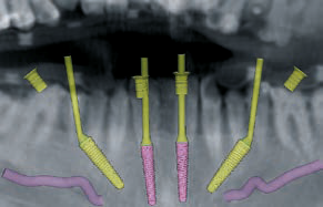 DVT-Planung: UK: Schonung des N. mandibularis inf. (beidseits).