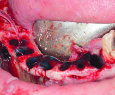 Extraktion der UK-Zähne bis auf 33 (Abstützung Bohrschablone), 12 Kürettage u. Desinfektion der Alveolen (PACT), Knochenplateau.